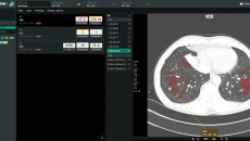 An interface of Coreline Soft's lung cancer screening analysis software An interface of Coreline Soft's lung cancer screening analysis software