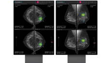 An analysis report generated by the Lunit INSIGHT DBT