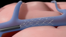 Animated image of Synchron's Stentrode device getting implanted into the brain